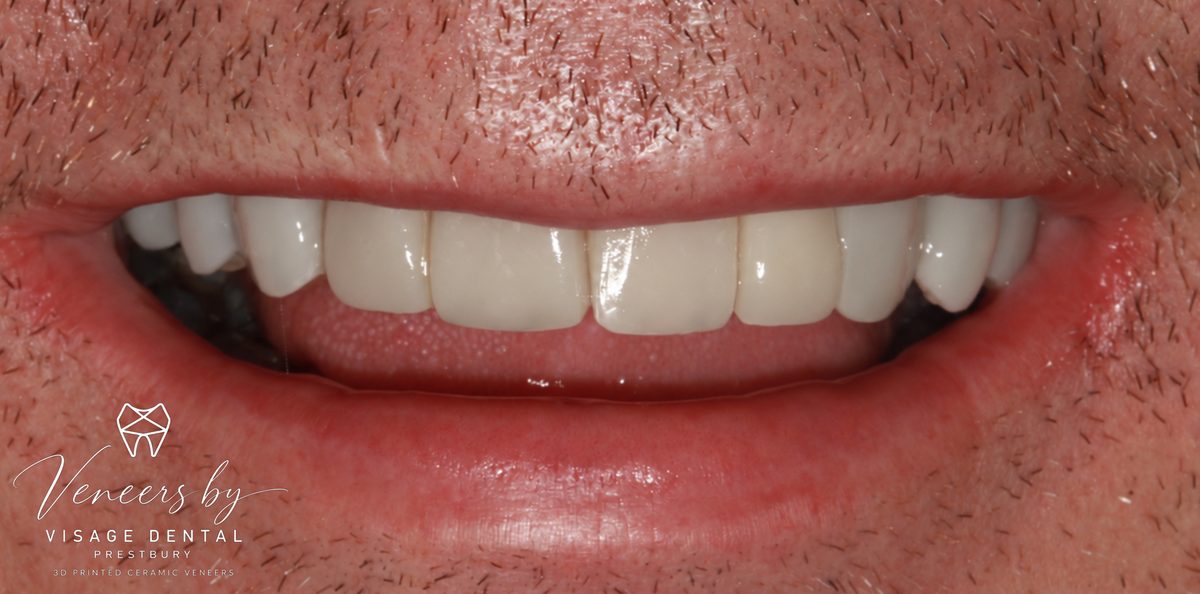 Case 1: the same patient's teeth after 3D printed ceramic veneers