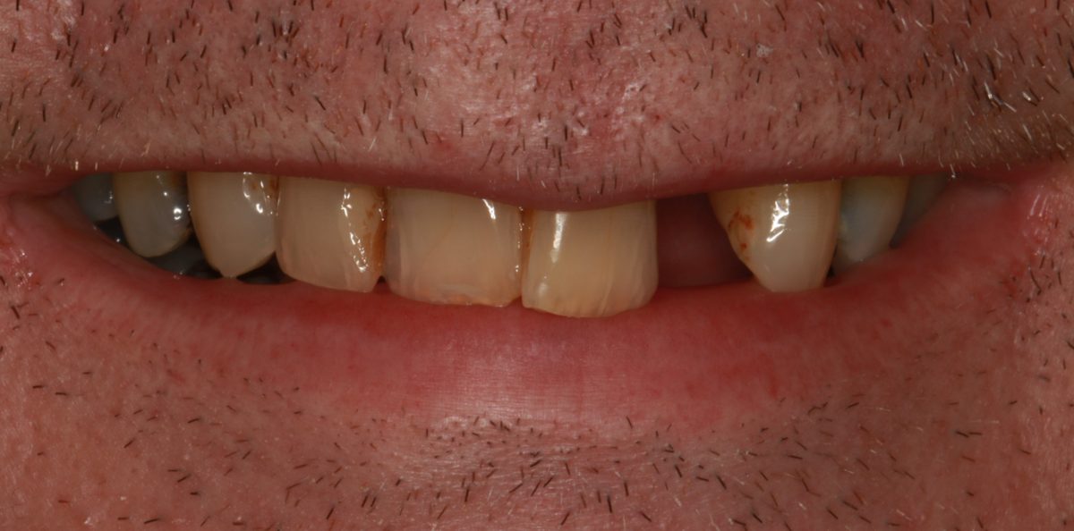 Case 1: patient's teeth before treatment