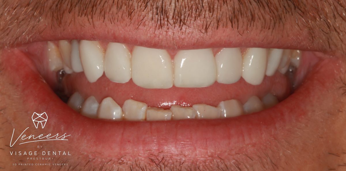 Case 2: the same patient's teeth after 3D printed ceramic veneers