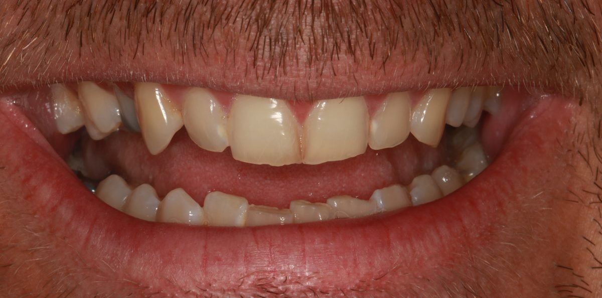 Case 2: patient's teeth before treatment