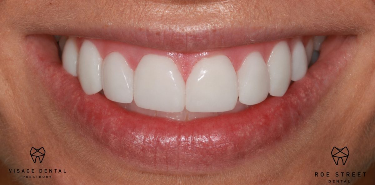 Case 3: the same patient's teeth after 3D printed ceramic veneers