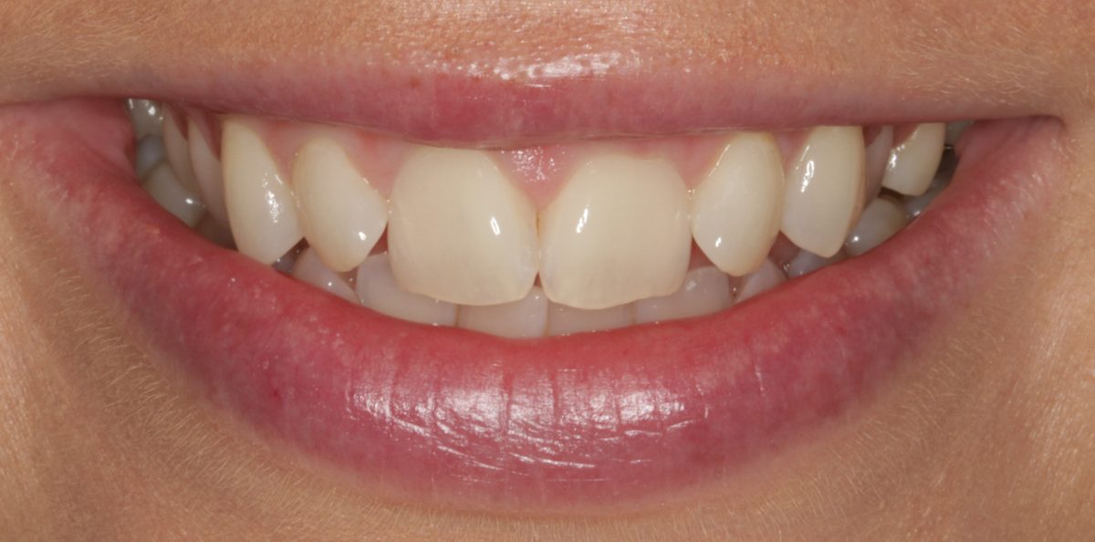 Case 3: patient's teeth before treatment