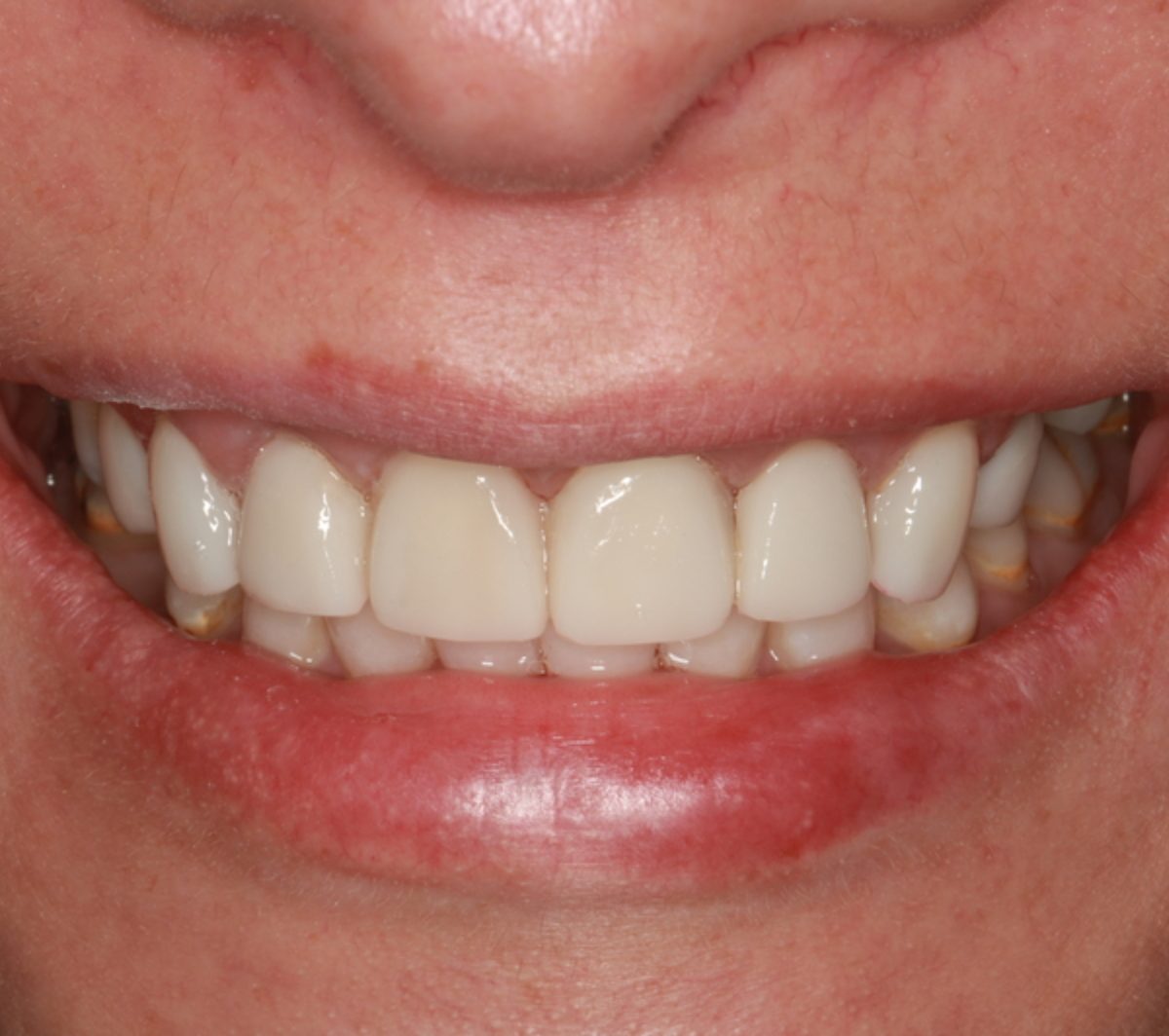 Case 4: the same patient's teeth after 3D printed ceramic veneers