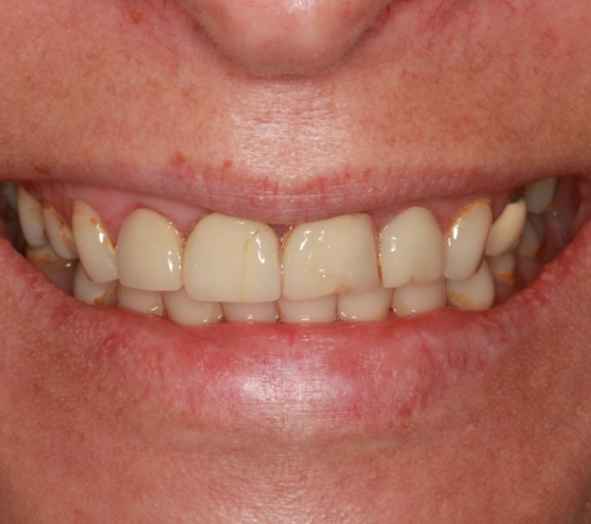Case 4: patient's teeth before treatment