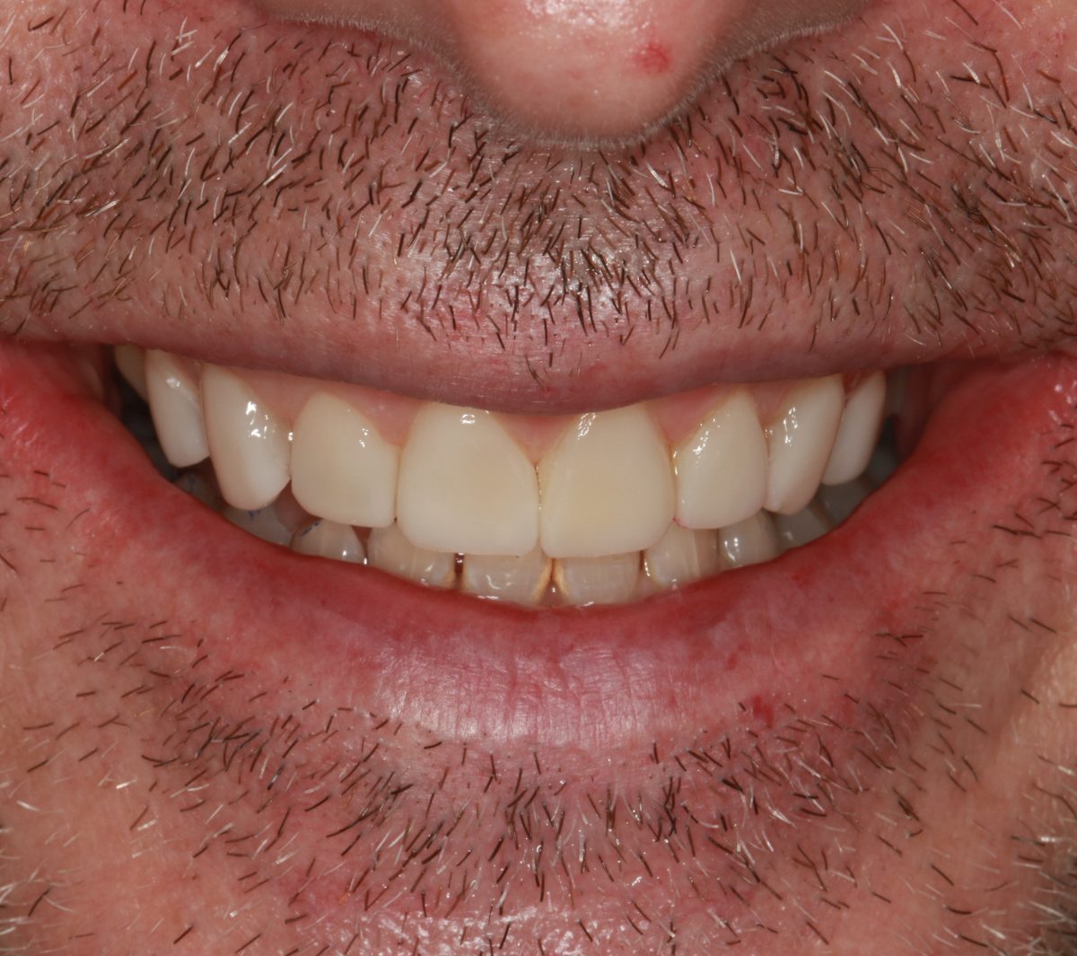 Case 5: the same patient's teeth after 3D printed ceramic veneers