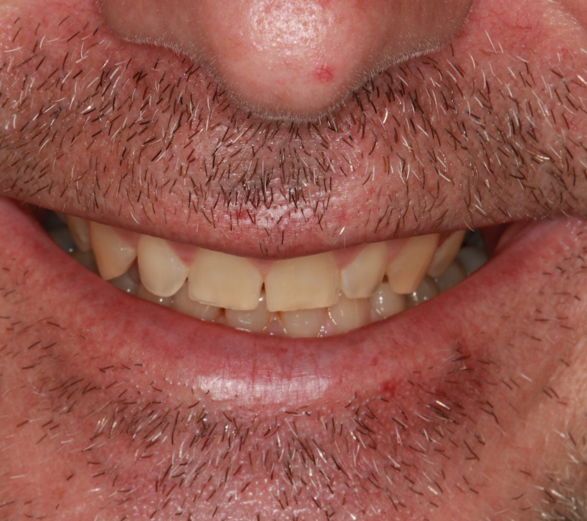 Case 5: patient's teeth before treatment