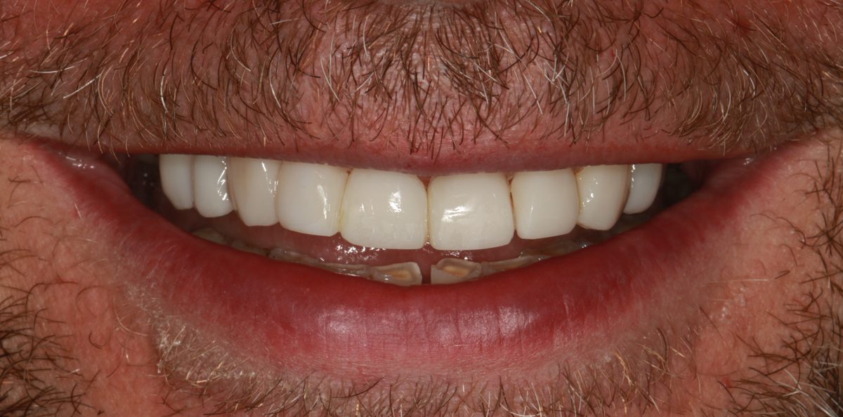 Case 6: the same patient's teeth after 3D printed ceramic veneers