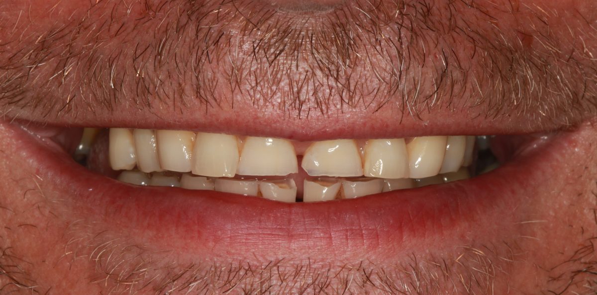 Case 6: patient's teeth before treatment