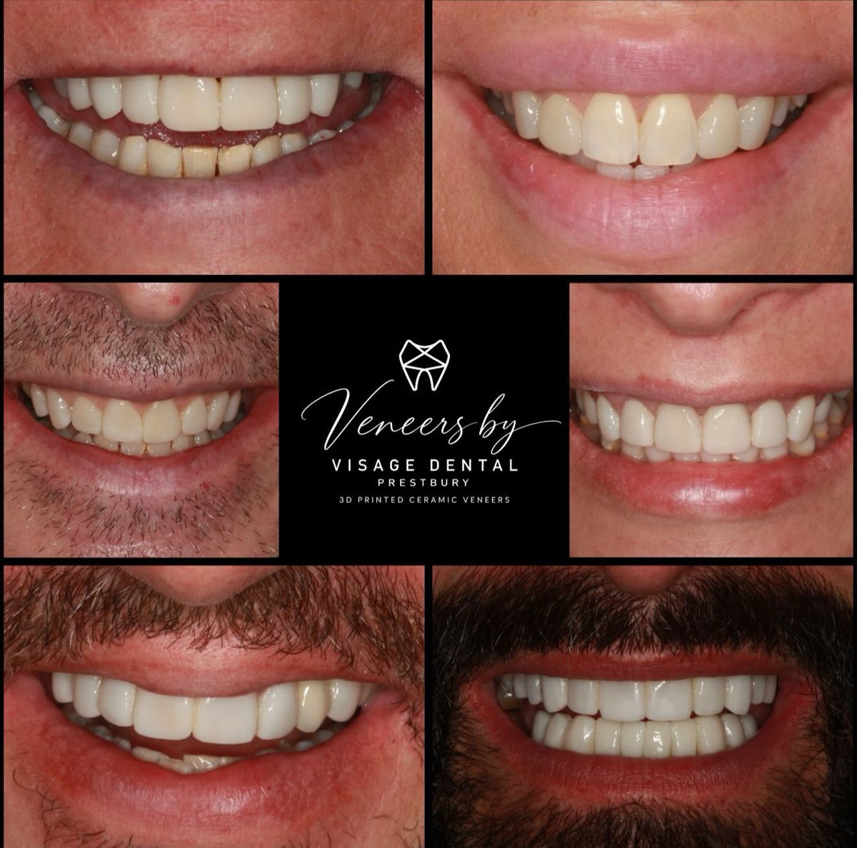 Collage of six smiles from patients treated with 3D printed ceramic veneers at Visage Dental Prestbury