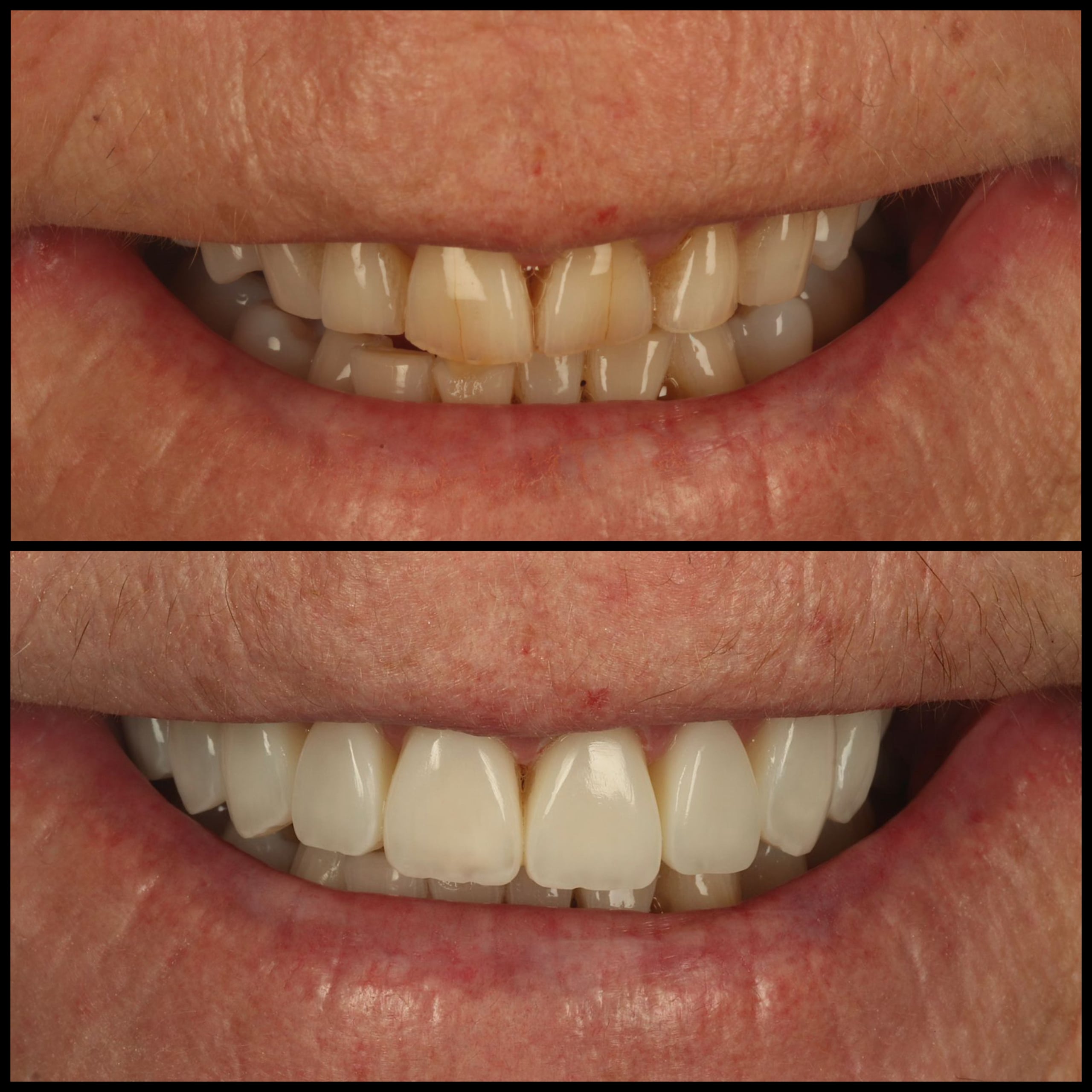 Composite Bonding Visage Dental Prestbury Dentist in Prestbury, Macclesfield
