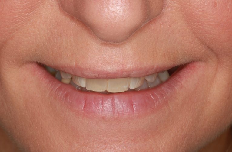 Before - Visage Dental