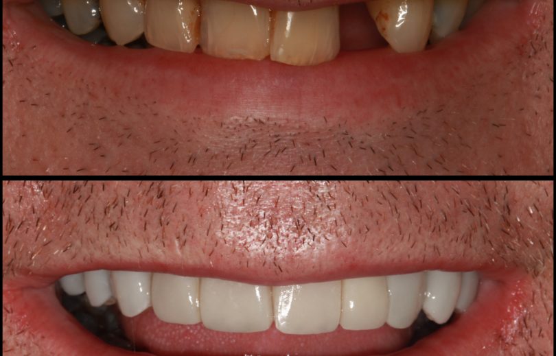 Before and after 3D printed ceramic veneers closing a gap, Visage Dental Prestbury