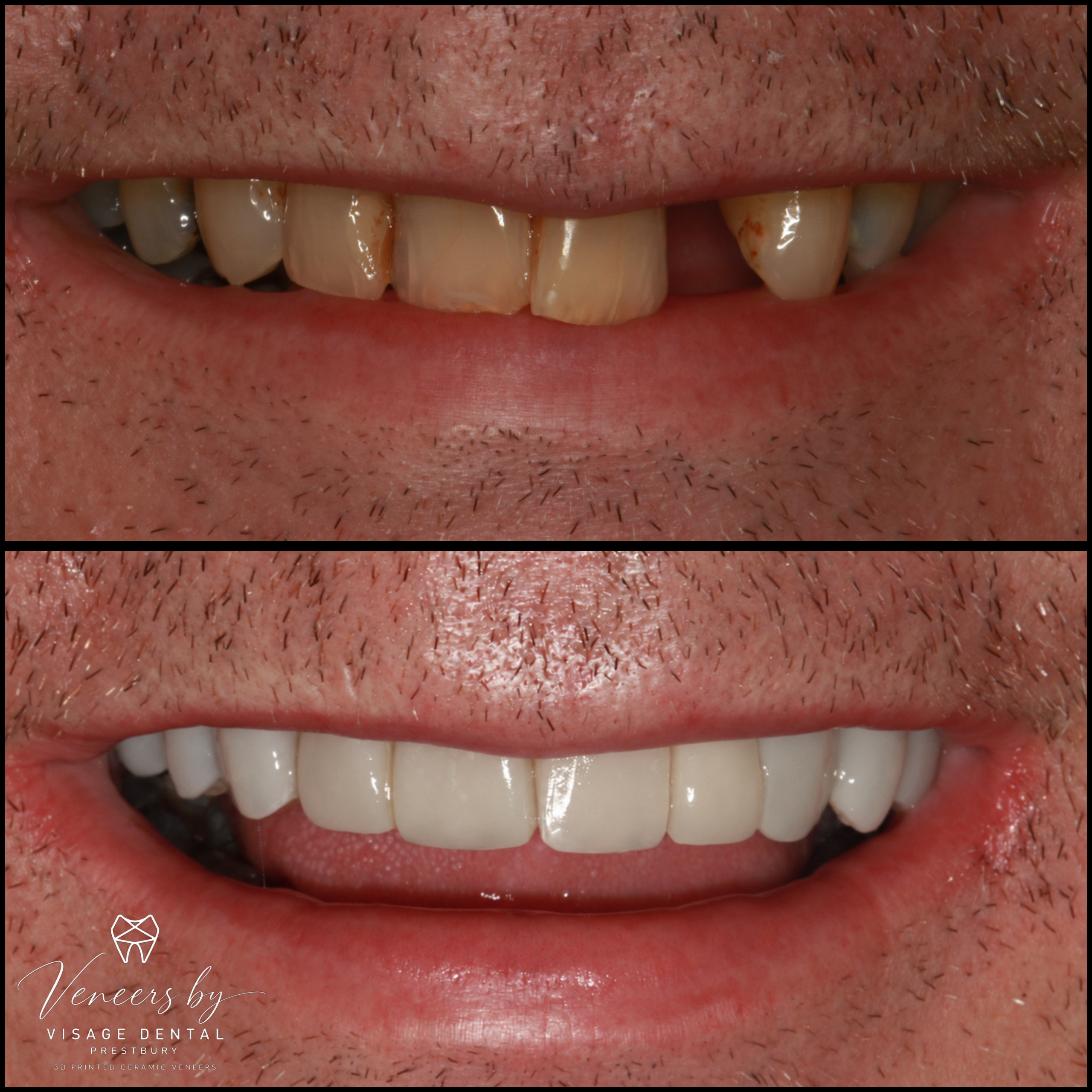 Before and after 3D printed ceramic veneers closing a gap, Visage Dental Prestbury