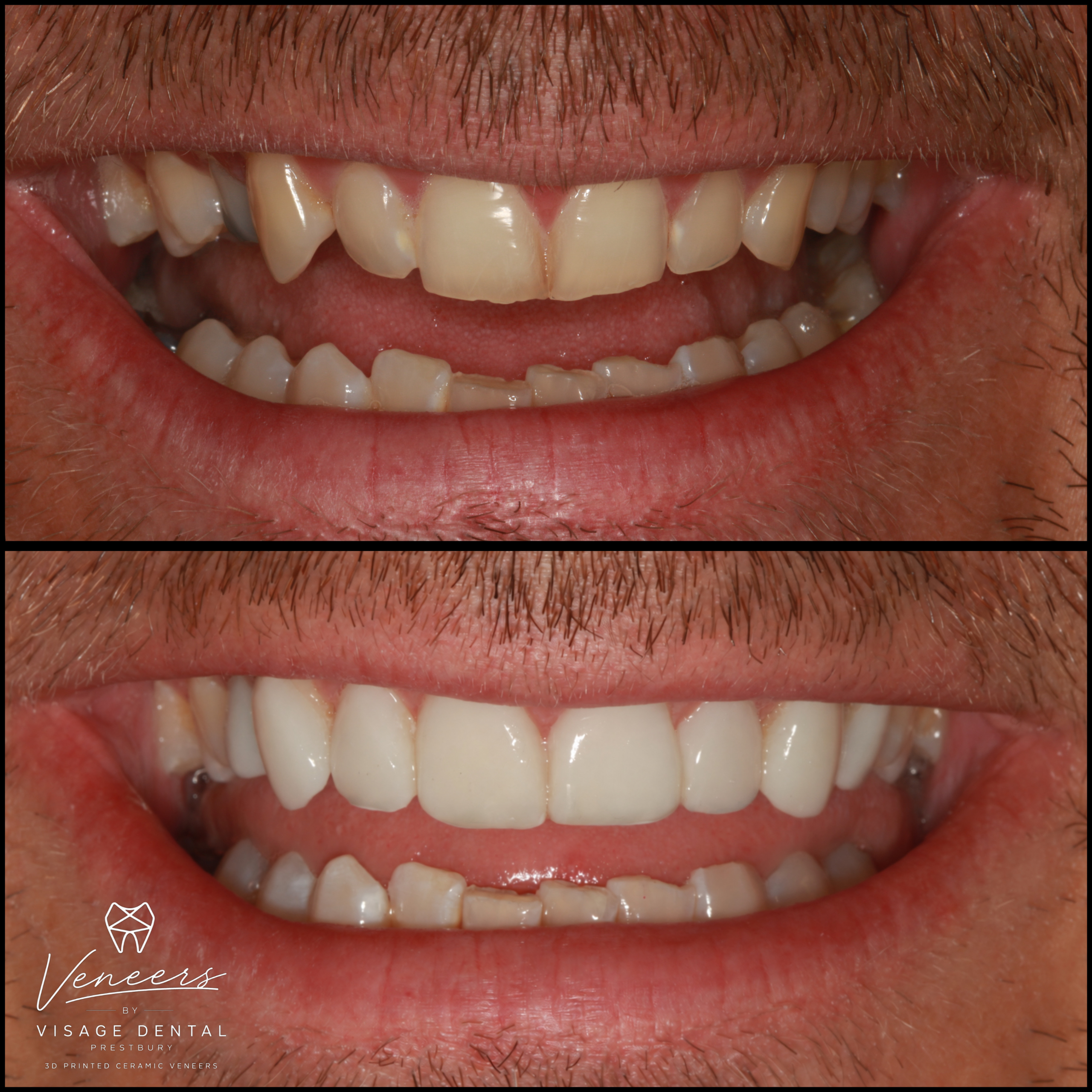 Before and after 3D printed ceramic veneers straightening a smile, Visage Dental Prestbury